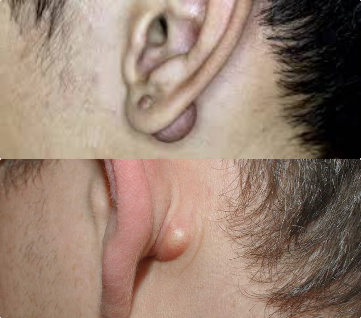 4 Metode untuk Mengatasi Benjolan di Belakang Telinga