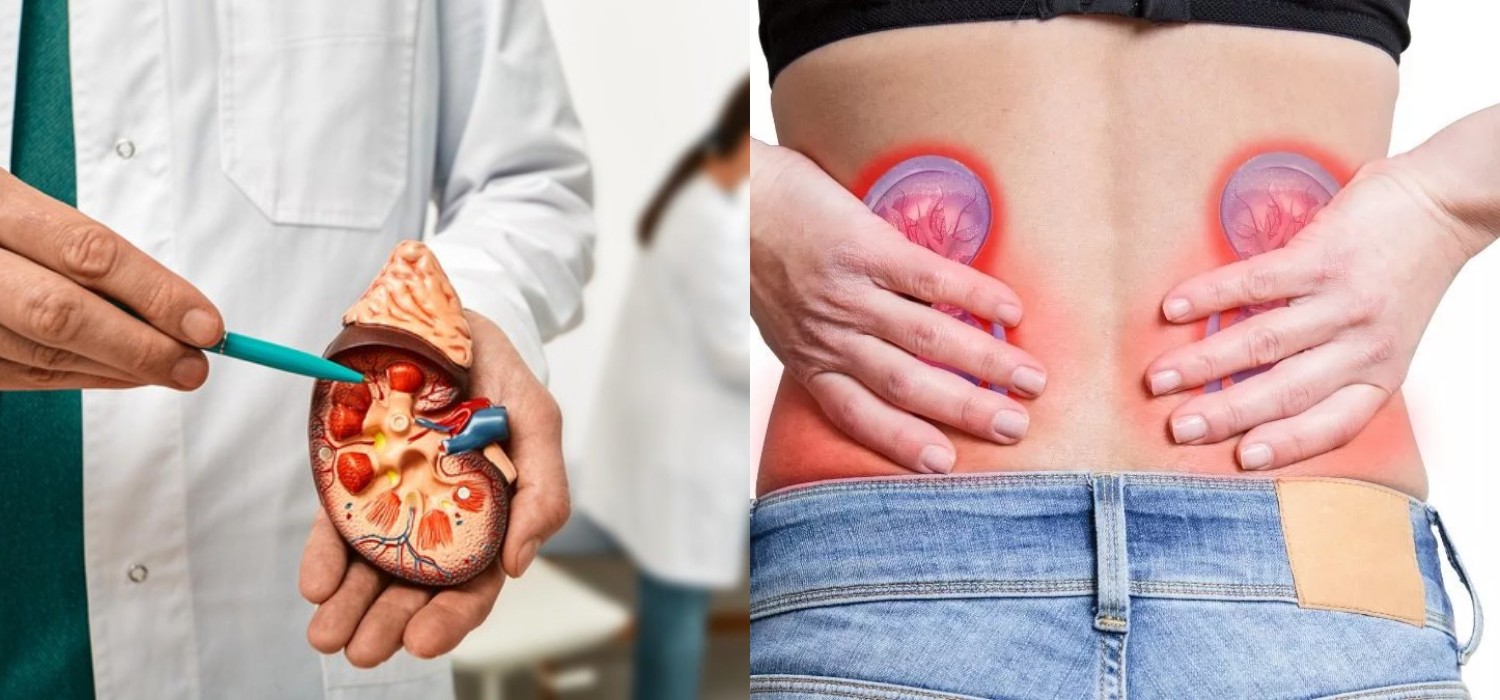 Hati-Hati! 10 Kebiasaan ini Bisa Memicu Batu Ginjal