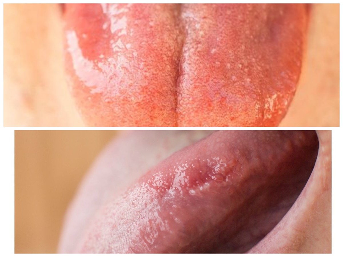 Cara Alami Atasi Radang Lidah: Redakan Nyeri dan Peradangan dengan Mudah