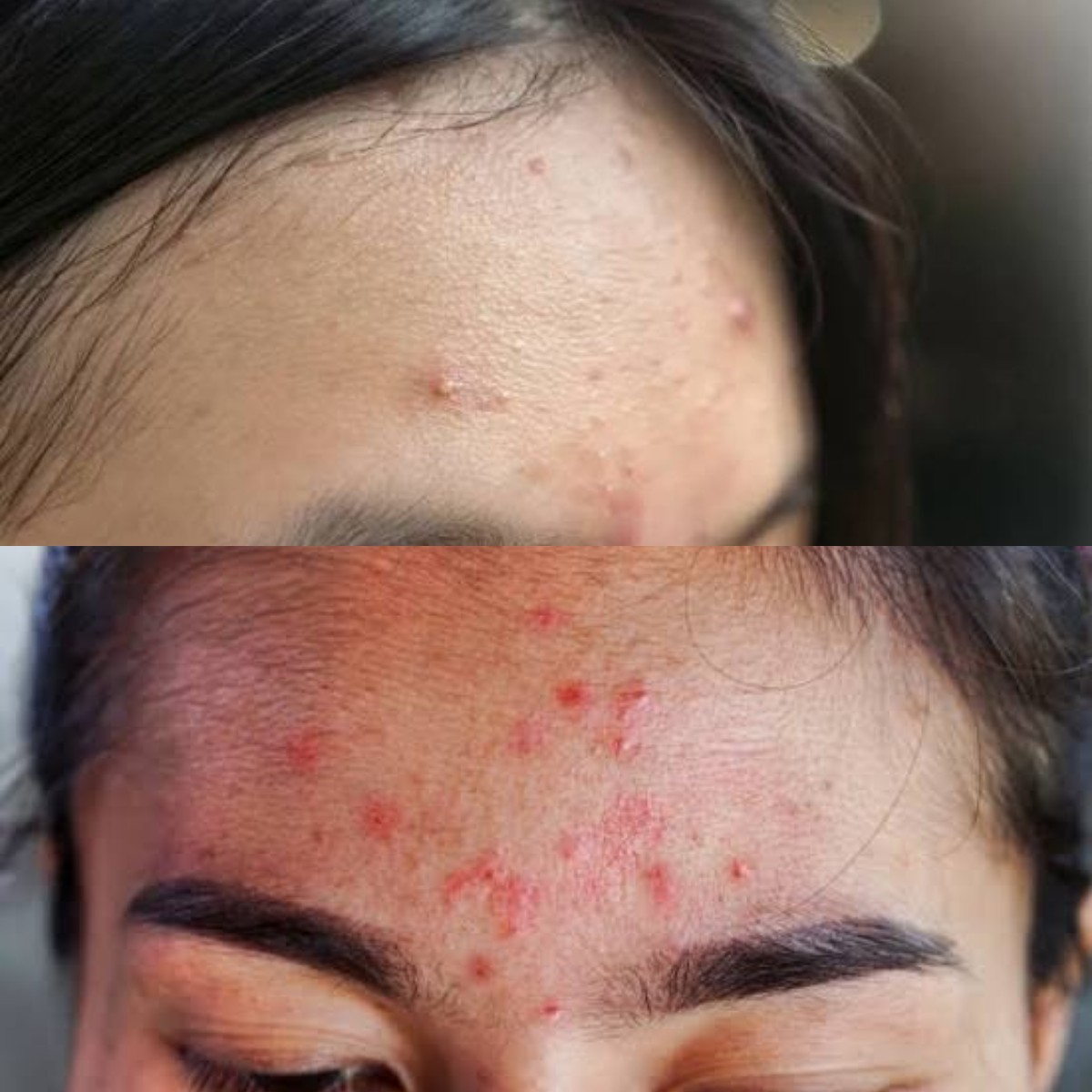 Sering Bikin Nggak Pede, Ini Faktor Utama Penyebab Jerawat di Jidat dan Tips Ampuh Menghilangkannya!