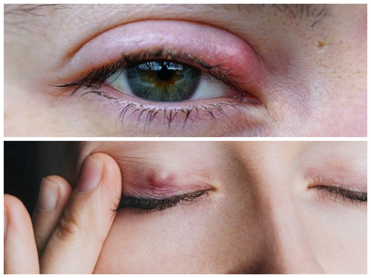 Kenali Benjolan di Bagian Dalam Mata serta Tips Pencegahannya