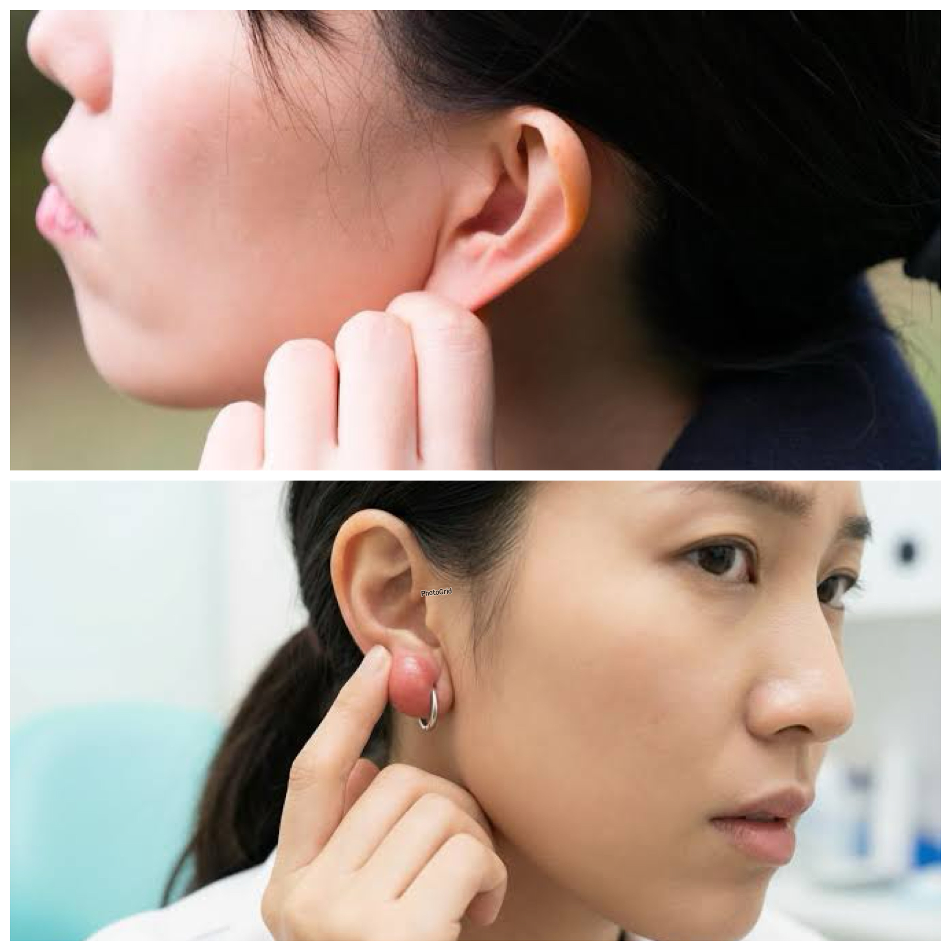 Kenapa Muncul Benjolan di Daun Telinga? Ini Penyebab dan Cara Mengatasinya!