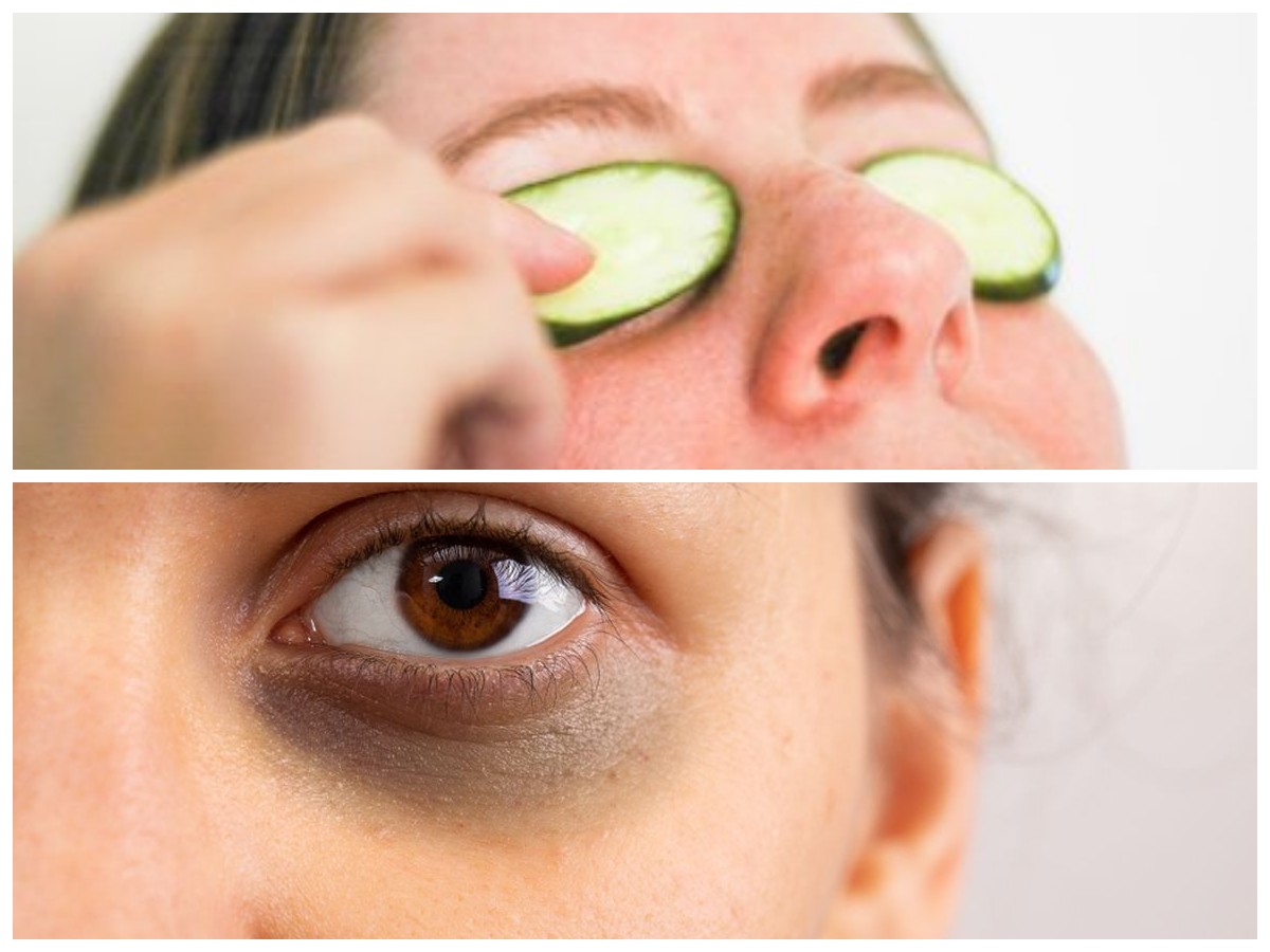 Cara Alami Mengatasi Lingkaran Hitam di Bawah Mata: 10 Langkah Efektif