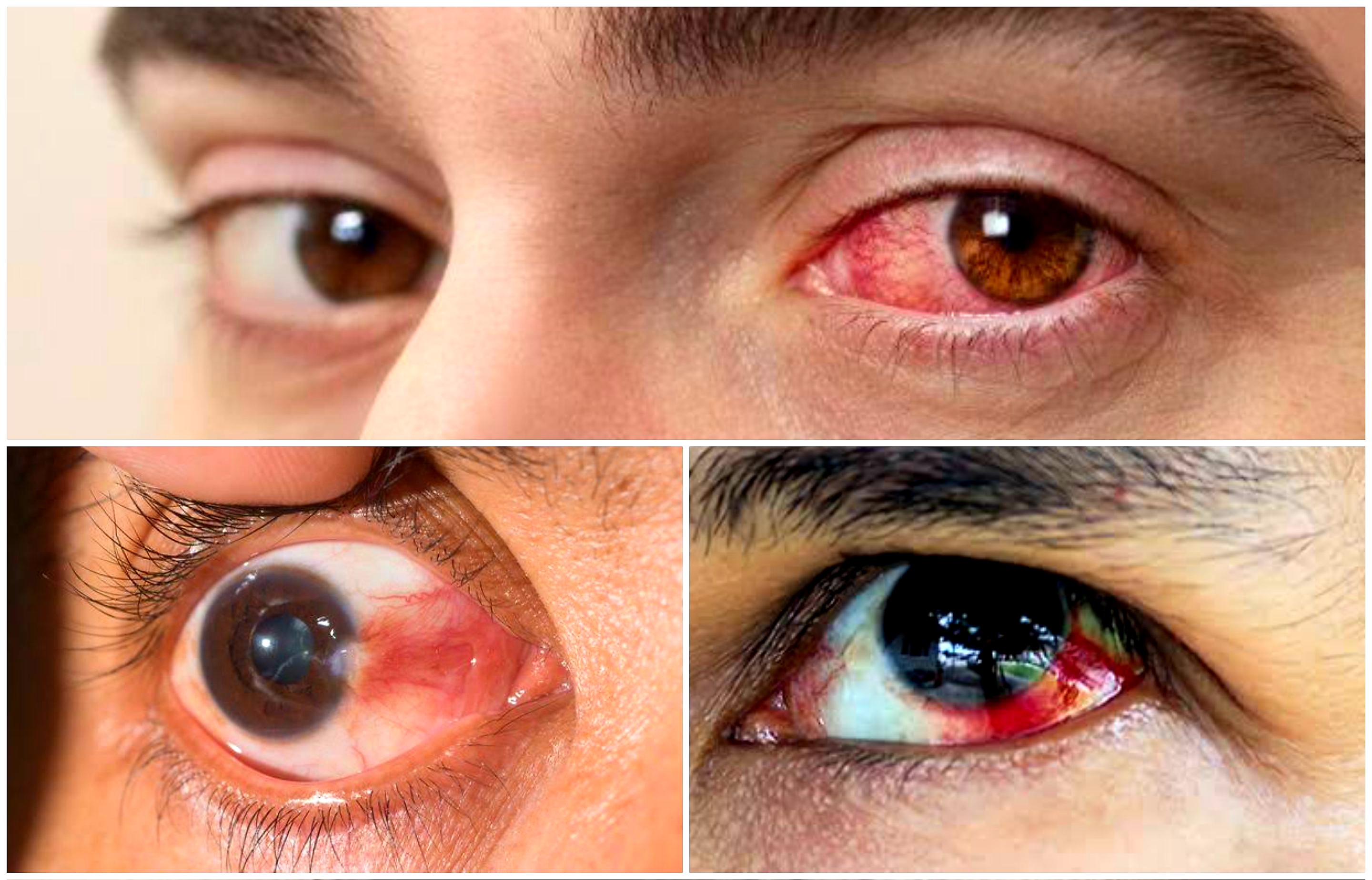 Atasi Mata Merah Sebelah Kiri Dari Yang Sederhana Hingga Pengobatan Medis