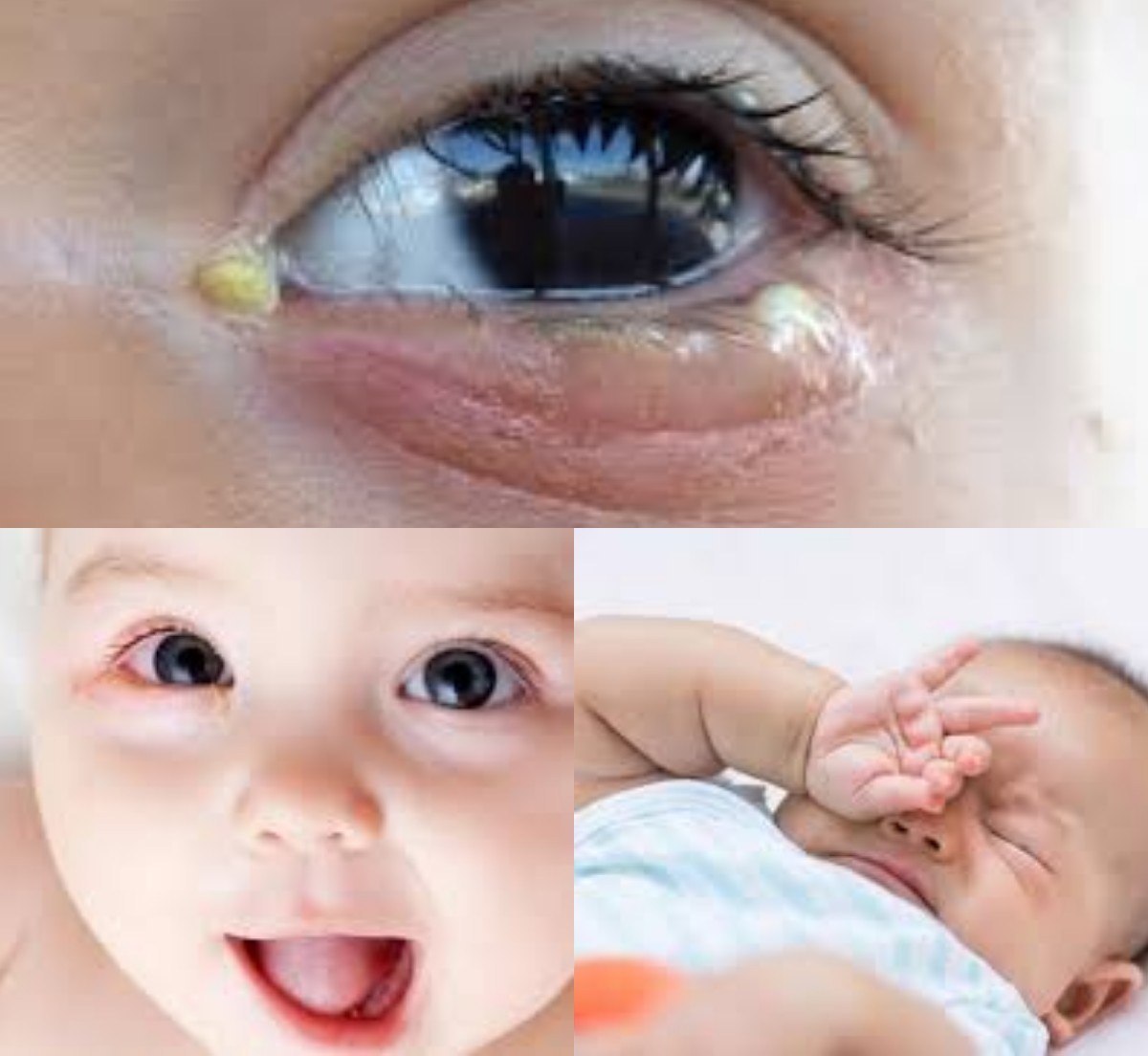 Buah Hati Sering Belekan? Ketahui Penyebab dan Cara Mengatasinya dengan Aman