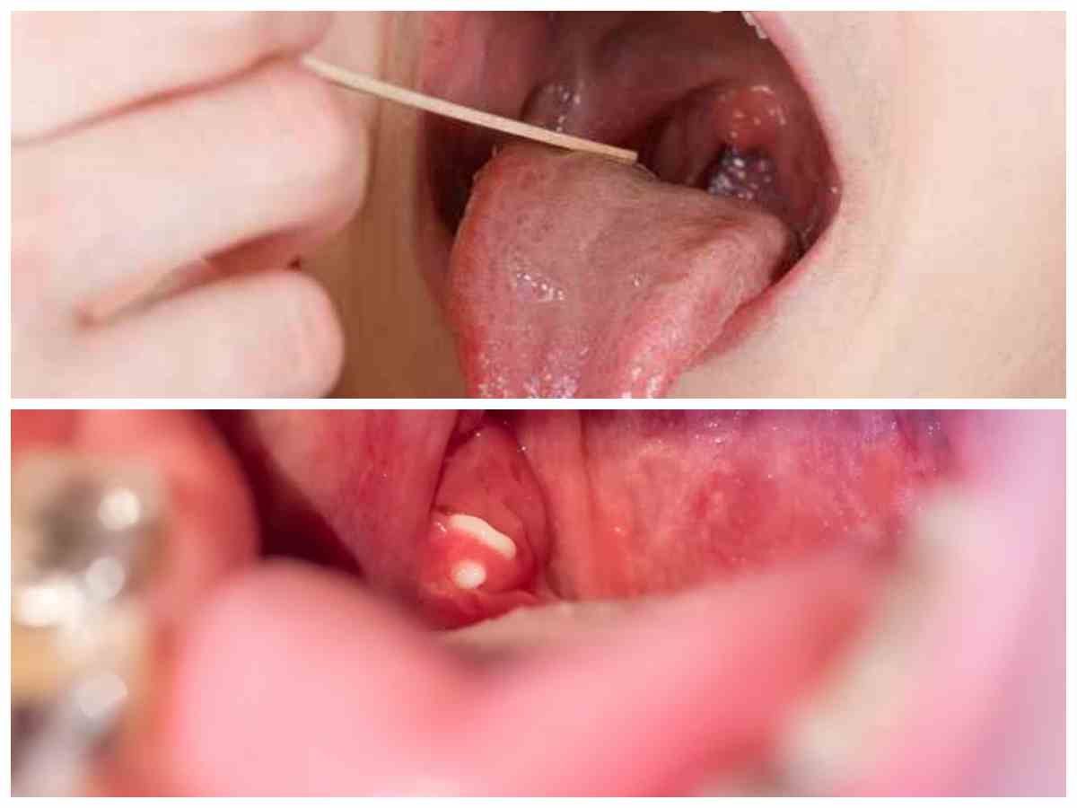 Waspadai! Sakit Tenggorokan Berulang Bisa Jadi Gejala Batu Amandel