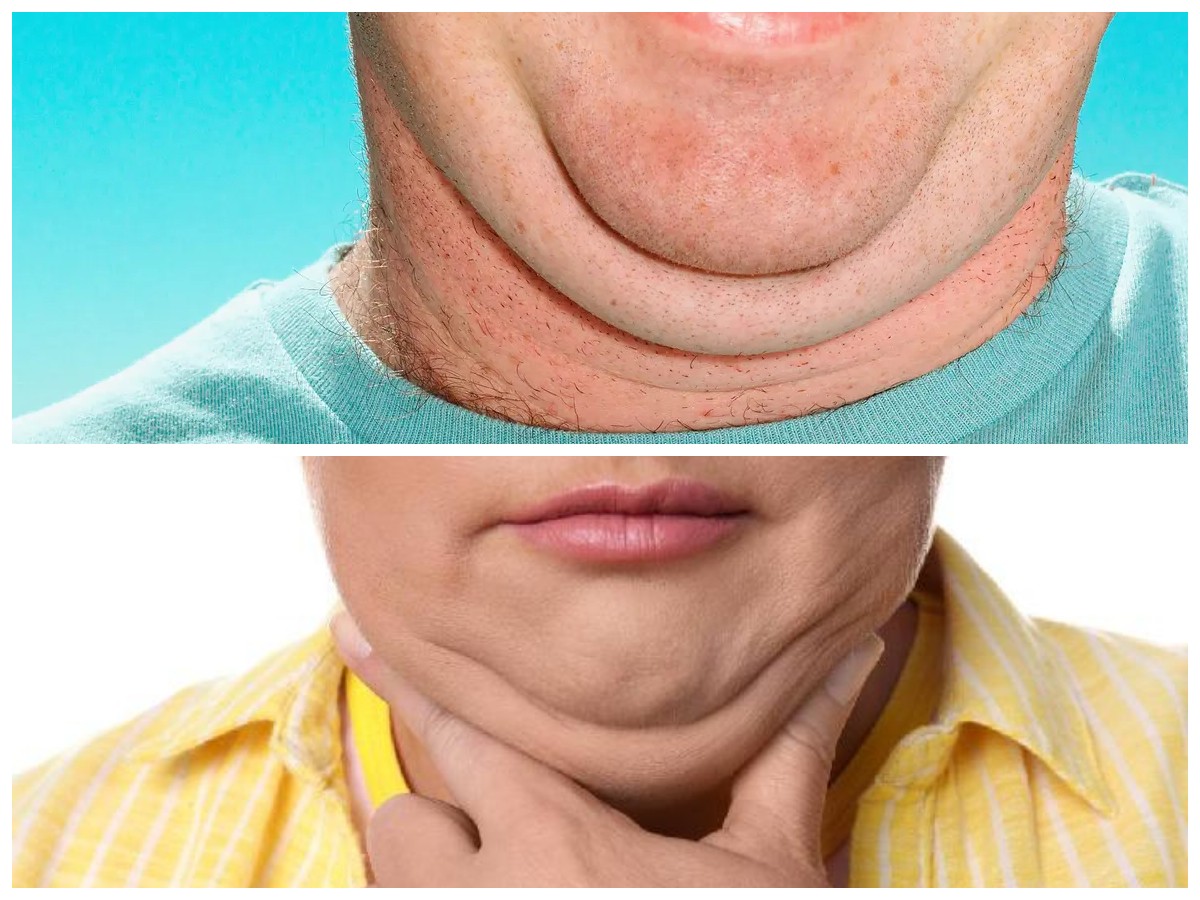 Hilangkan Double Chin Secara Alami: Kenali Penyebab dan Cara Mengatasinya dengan Mudah