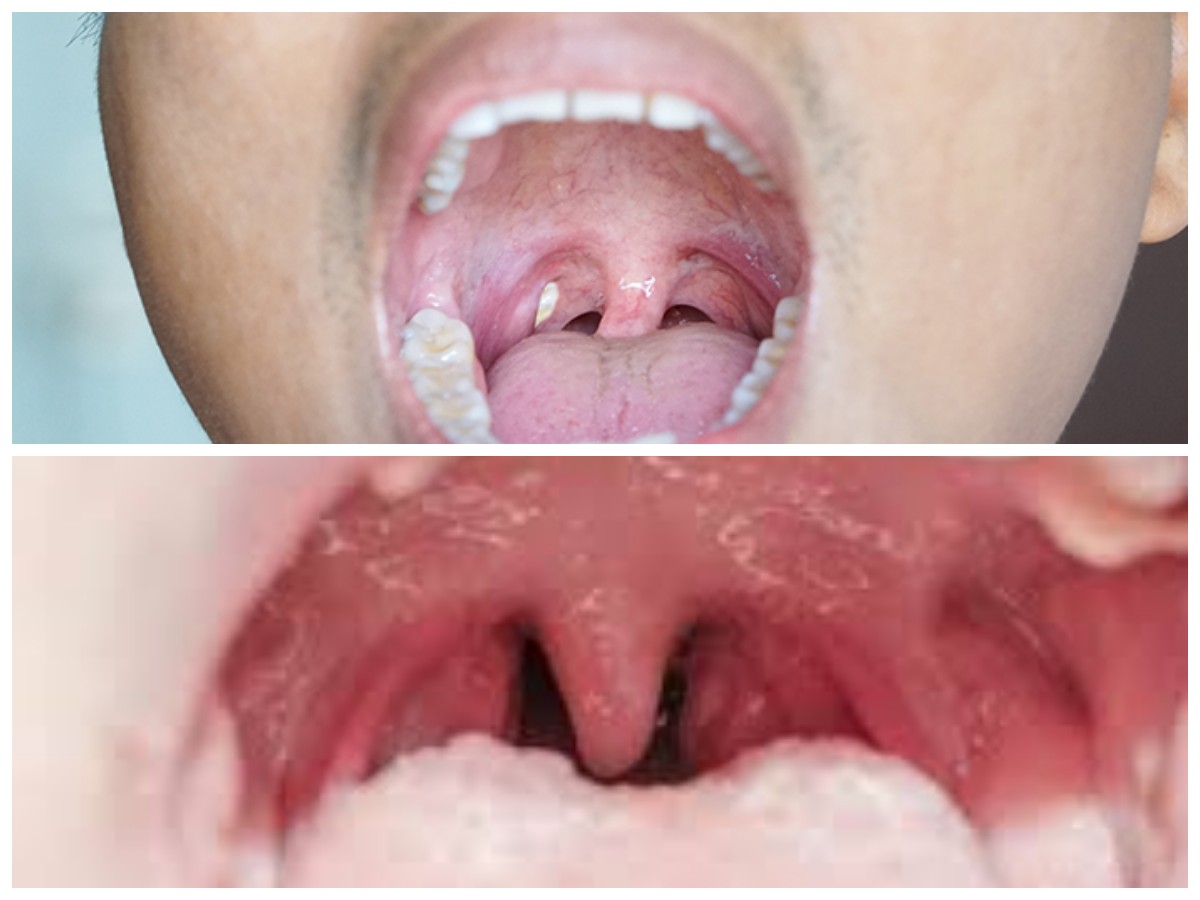 Mengenal Batu Amandel: Penyebab, Gejala, dan Langkah Pencegahan yang Perlu Diketahui