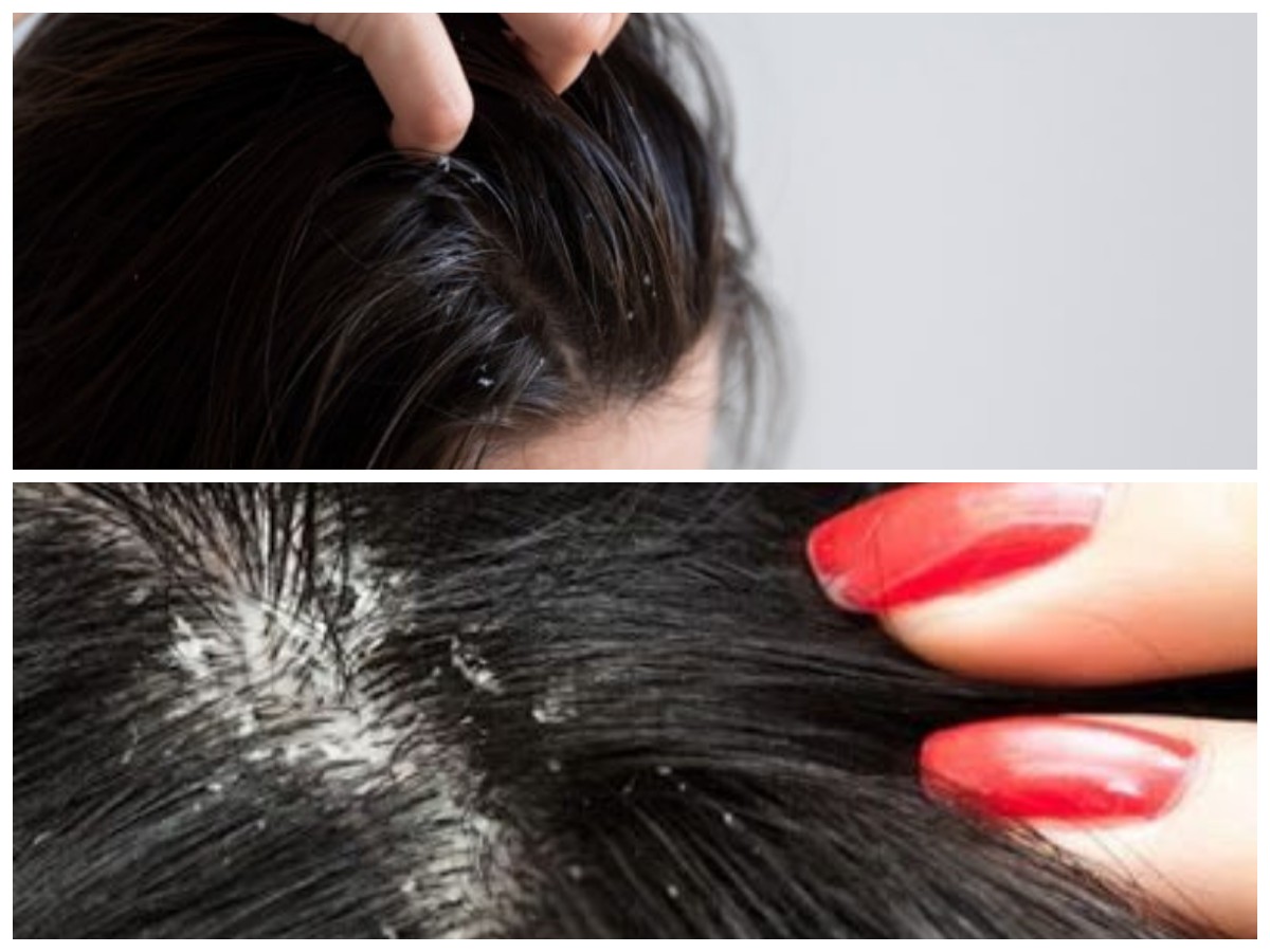 Cara Ampuh Menghilangkan Ketombe: 7 Tips yang Wajib Dicoba