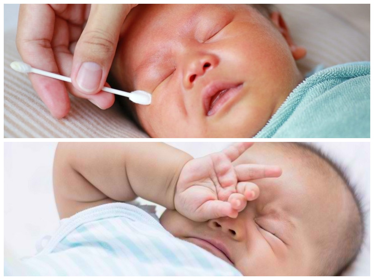 Apakah Belek pada Bayi Baru Lahir Wajar? Ini Penyebab dan Cara Mengatasinya