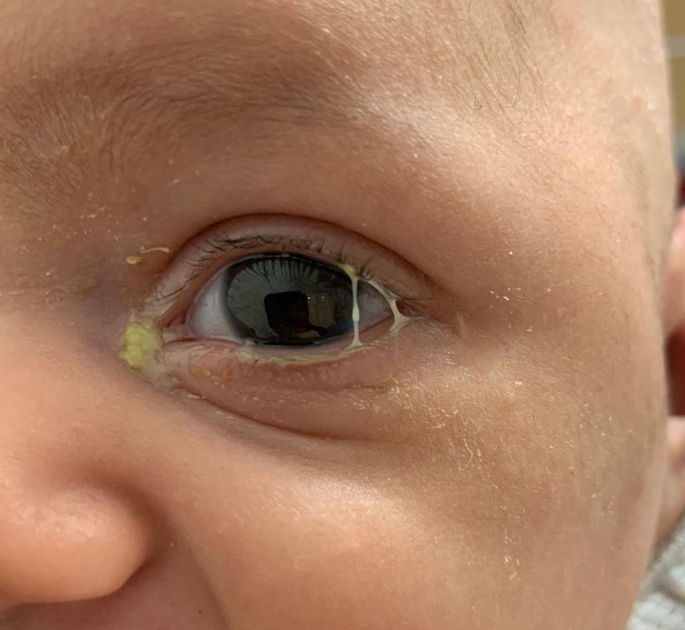 Mata Bayi Sering Belekan? Ikuti Cara Ini untuk Menanganinya 