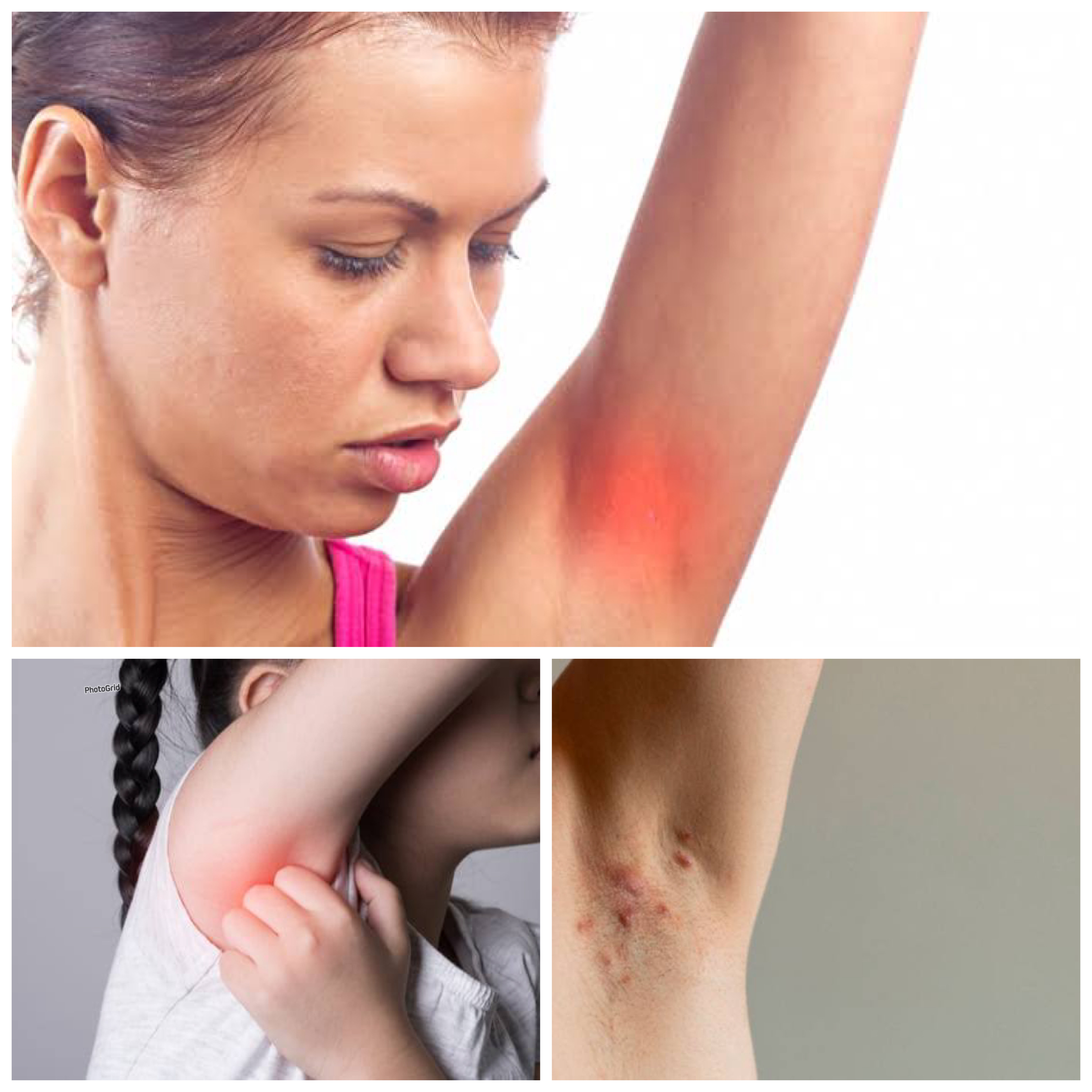 Tips Mengatasi Bisul pada Ketiak serta Penyebabnya: Panduan Lengkap untuk Perawatan dan Pencegahan!