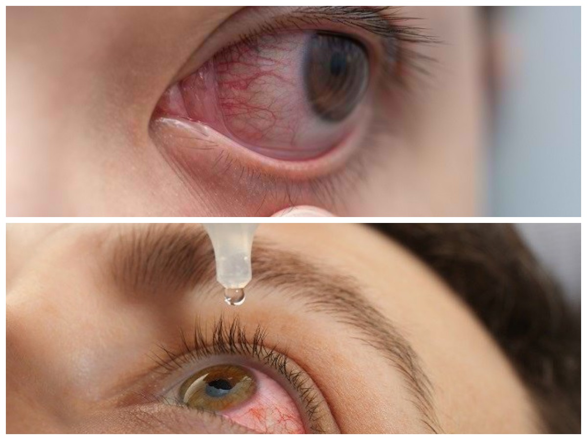 Tips Ampuh Atasi Mata Merah Akibat Debu dan Polusi