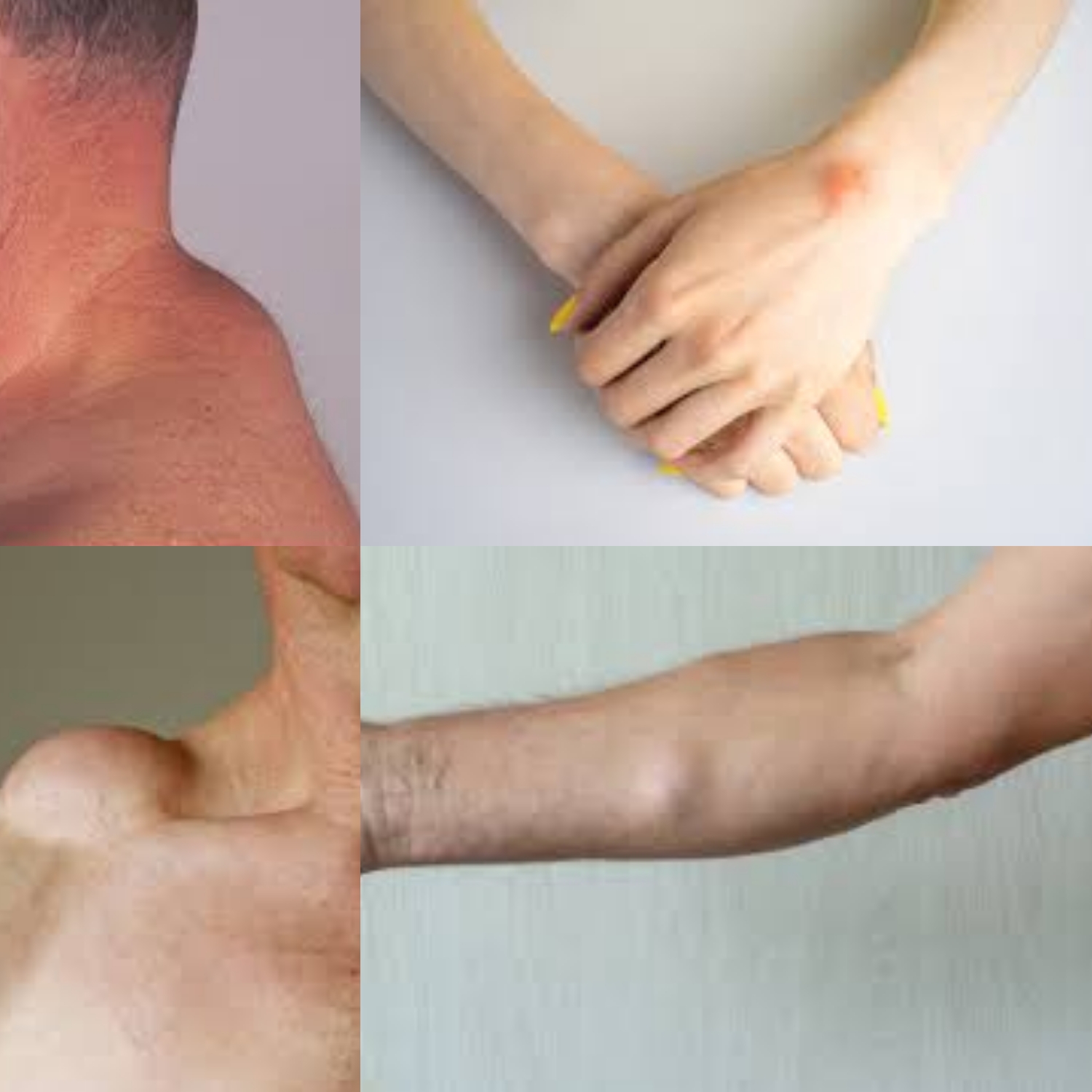 Lipoma, Benjolan di Bagian tubuh yang Perlu Diperhatikan!