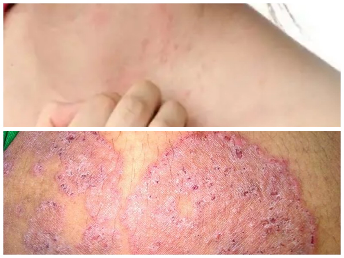 Gejala Alergi Jamur dan Solusi Pengobatannya: Panduan Lengkap untuk Hidup Lebih Sehat