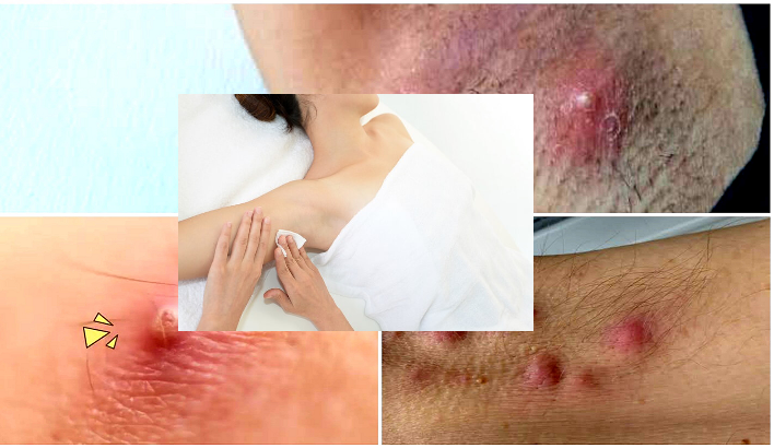 Jangan Anggap Sepele! Ini Penyebab Bisul di Ketiak yang Jarang Diketahui, No. 4 Paling Mengejutkan!