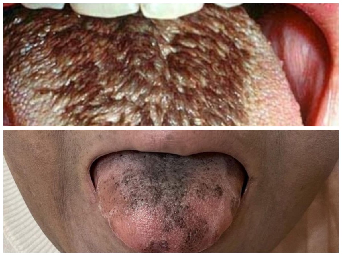 Waspadai Lidah Hitam dan Berbulu! Ini 6 Penyebab Umum yang Jarang Disadar