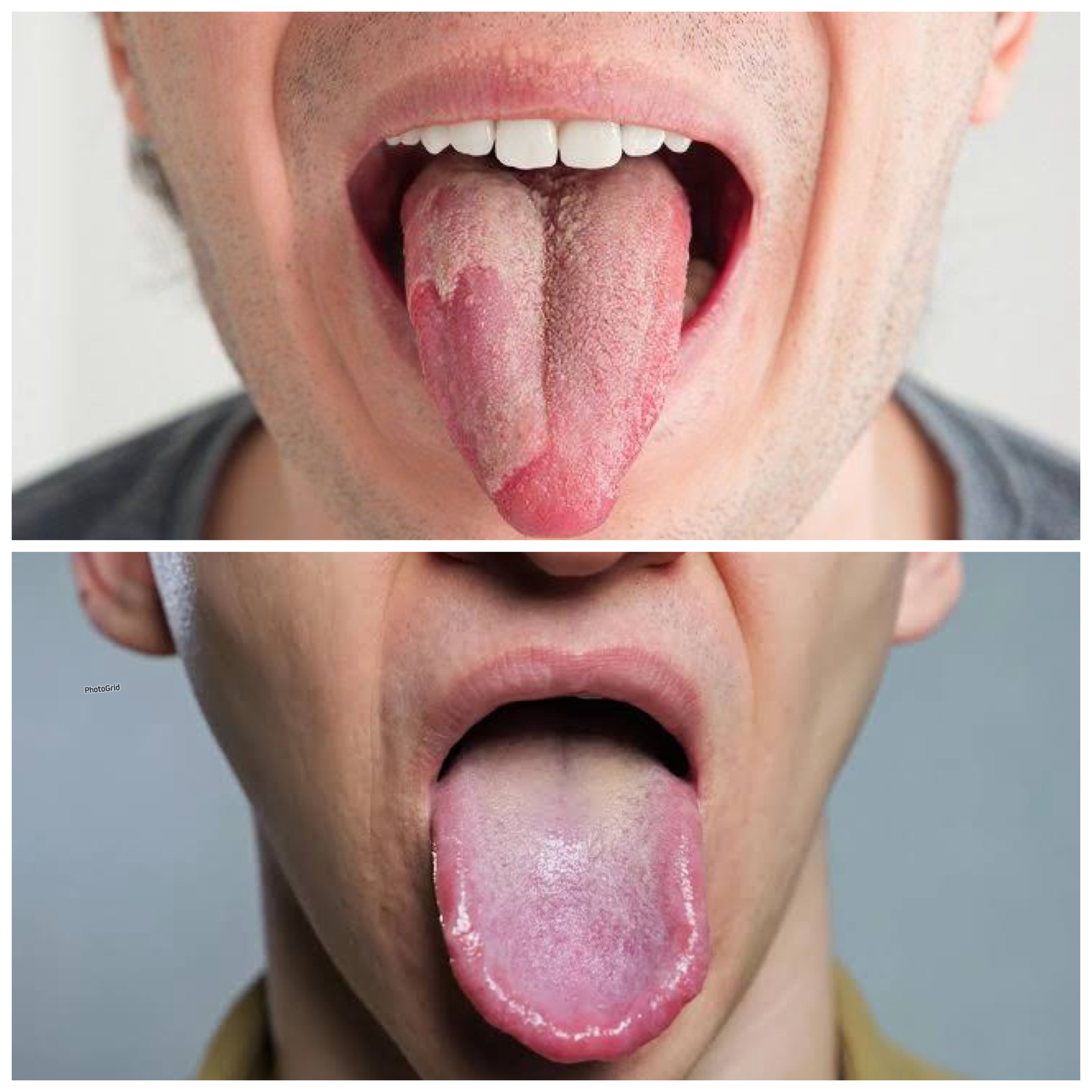 Mengatasi Radang Lidah yang Mengganggu Aktivitasmu: Cara Ampuh Meredakan Nyeri dan Peradangan Secara Alami