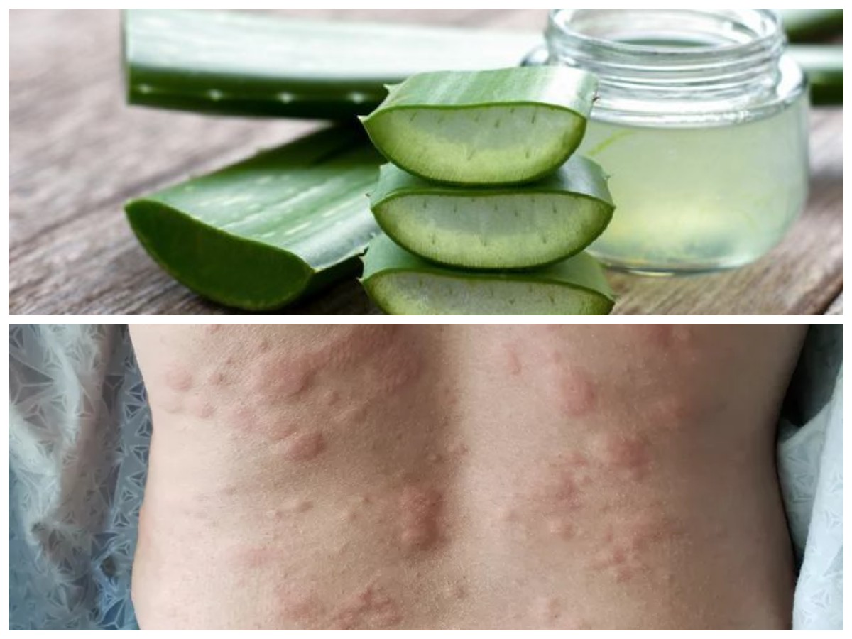 Biduran Tak Kunjung Hilang? Coba Ramuan Alami Ini untuk Redakan Gatal Secara Efektif!