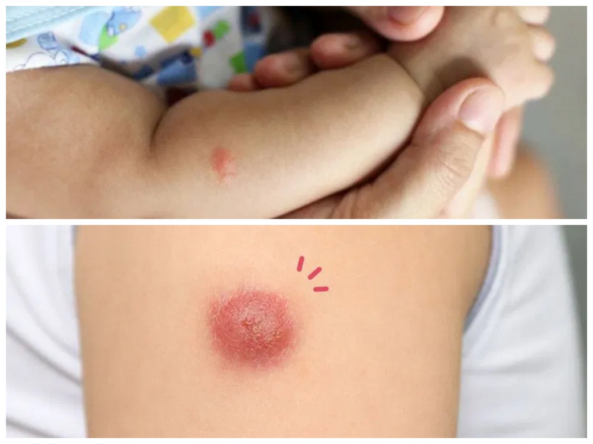 Bayi Tumbuh Bisul? Kenali 4 Penyebab Utamanya Sejak Dini