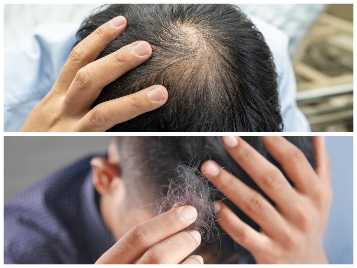 Rambut Pria Gampang Rontok? Ini Penyebab dan Cara Merawatnya agar Tetap Kuat!