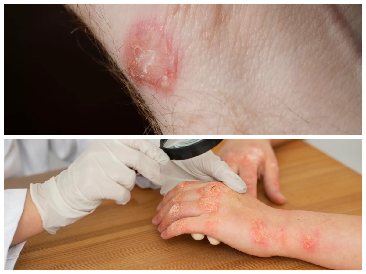 5 Infeksi Kulit Akibat Bakteri yang Sering Terjadi dan Tips Mengobatinya