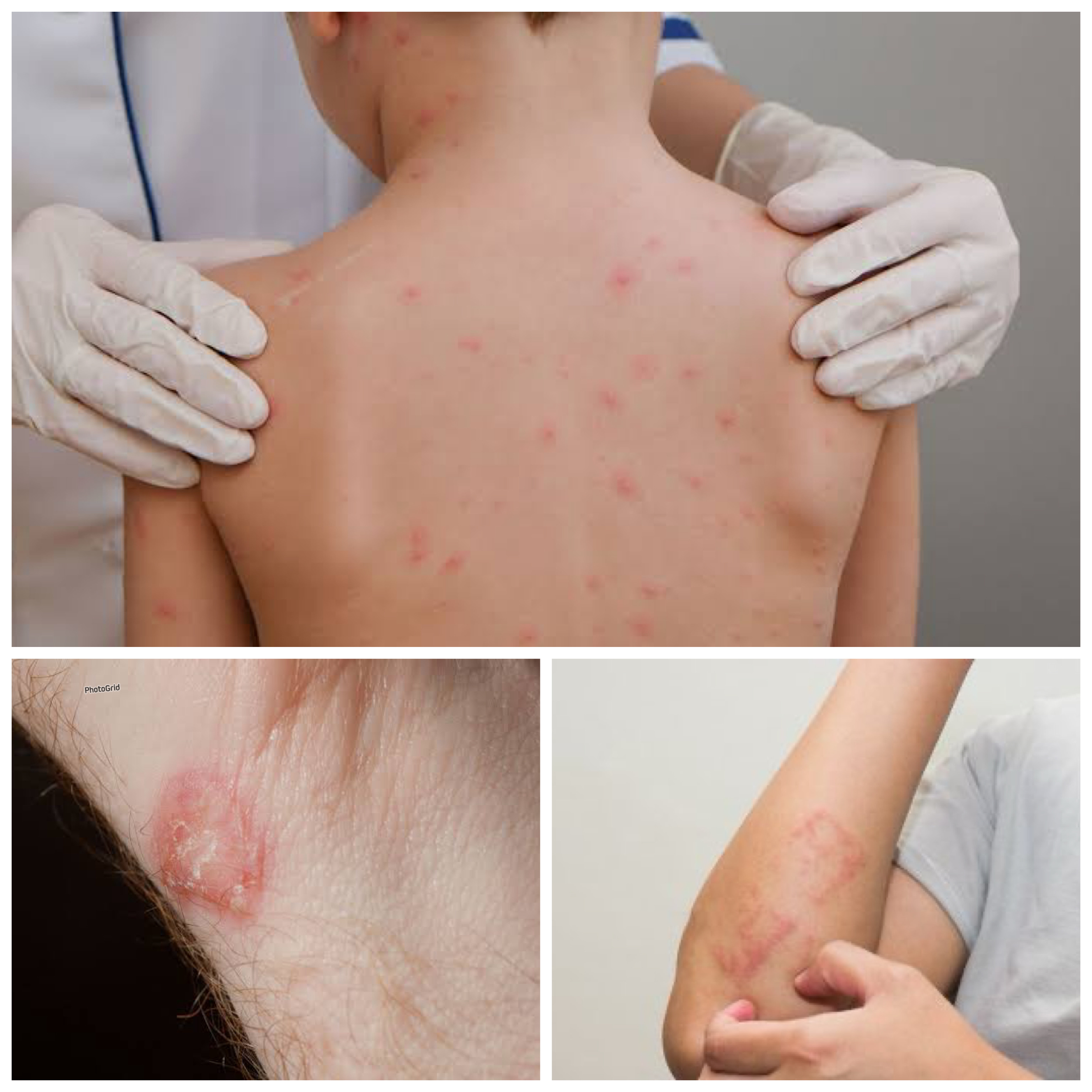 Mengenal Infeksi Kulit Akibat Bakteri: Ancaman Kecil yang Bisa Jadi Serius dan Penanganan Pertama!