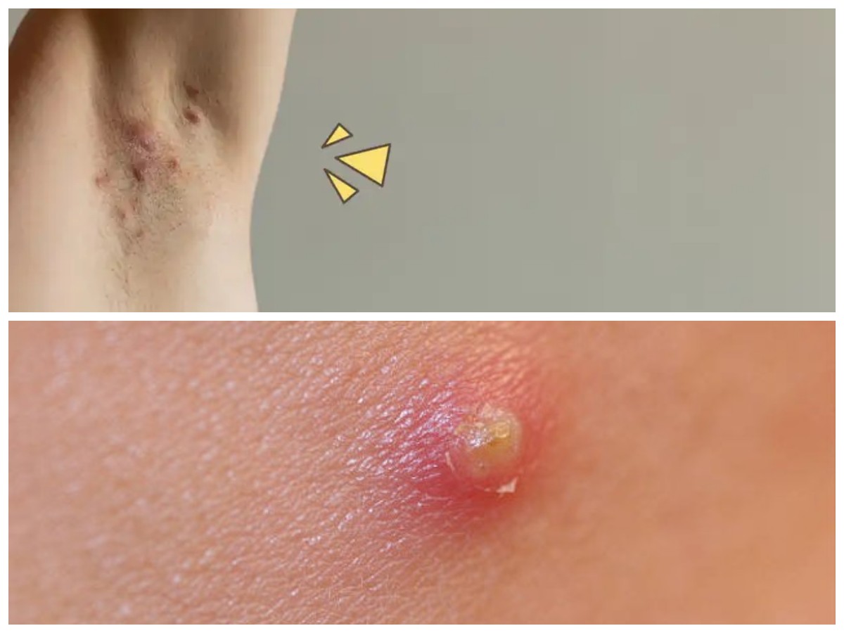 Penyebab Bisul di Ketiak yang Sering Terlupakan dan Cara Mengatasinya