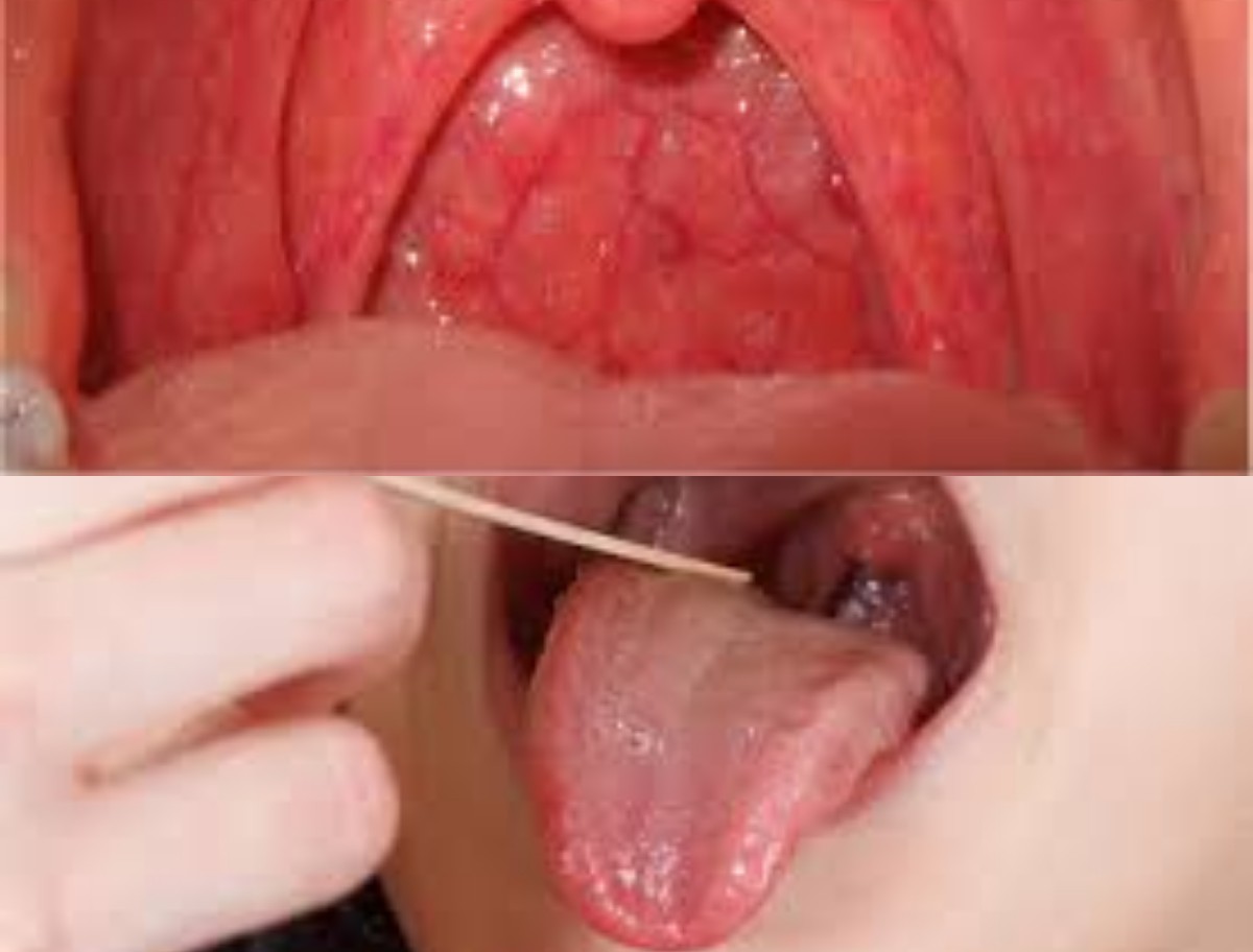 Waspadai Penyakit Amandel: Gejala, Penyebab, dan Penanganan yang Perlu Diketahui Sejak Dini