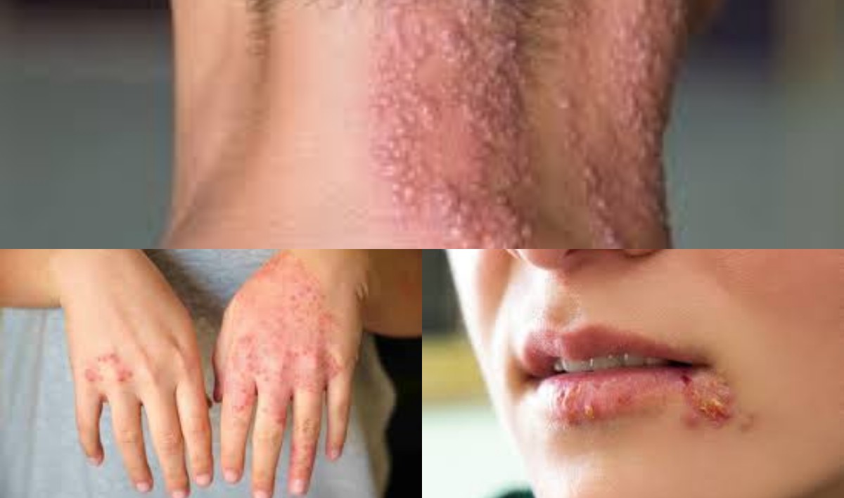 Kenali 7 Tipe Penyakit Kulit dan Cara Penanganannya!