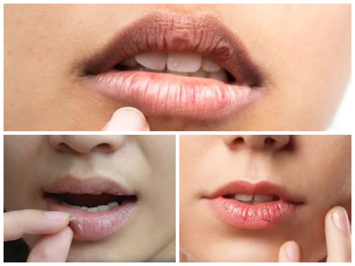 Bibir Kering, Pecah-pecah, 9 Tips Mengatasi ? Agar Bibir Kembali Lembab!