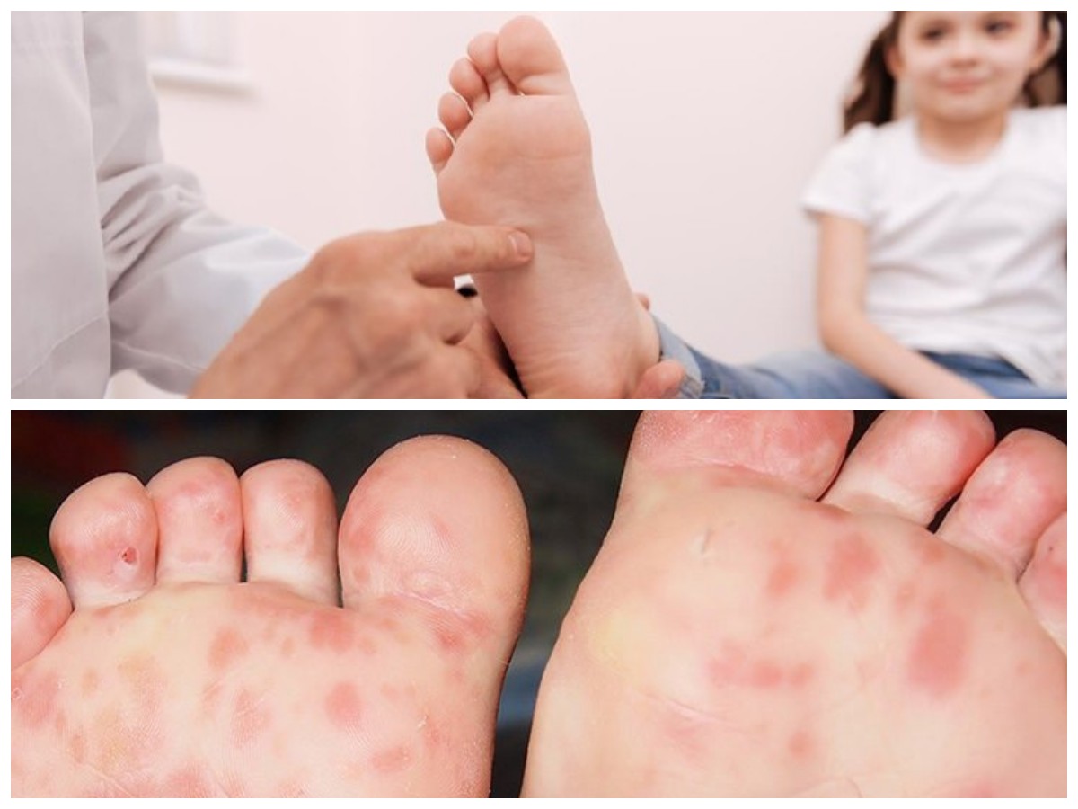 Gatal di Telapak Kaki Tak Kunjung Hilang? Ini Faktor Pemicu dan Cara Mengobatinya Secara Efektif!