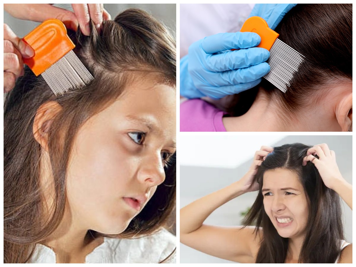 Berbagai Tips Menghilangkan Kutu Rambut dan Telurnya!