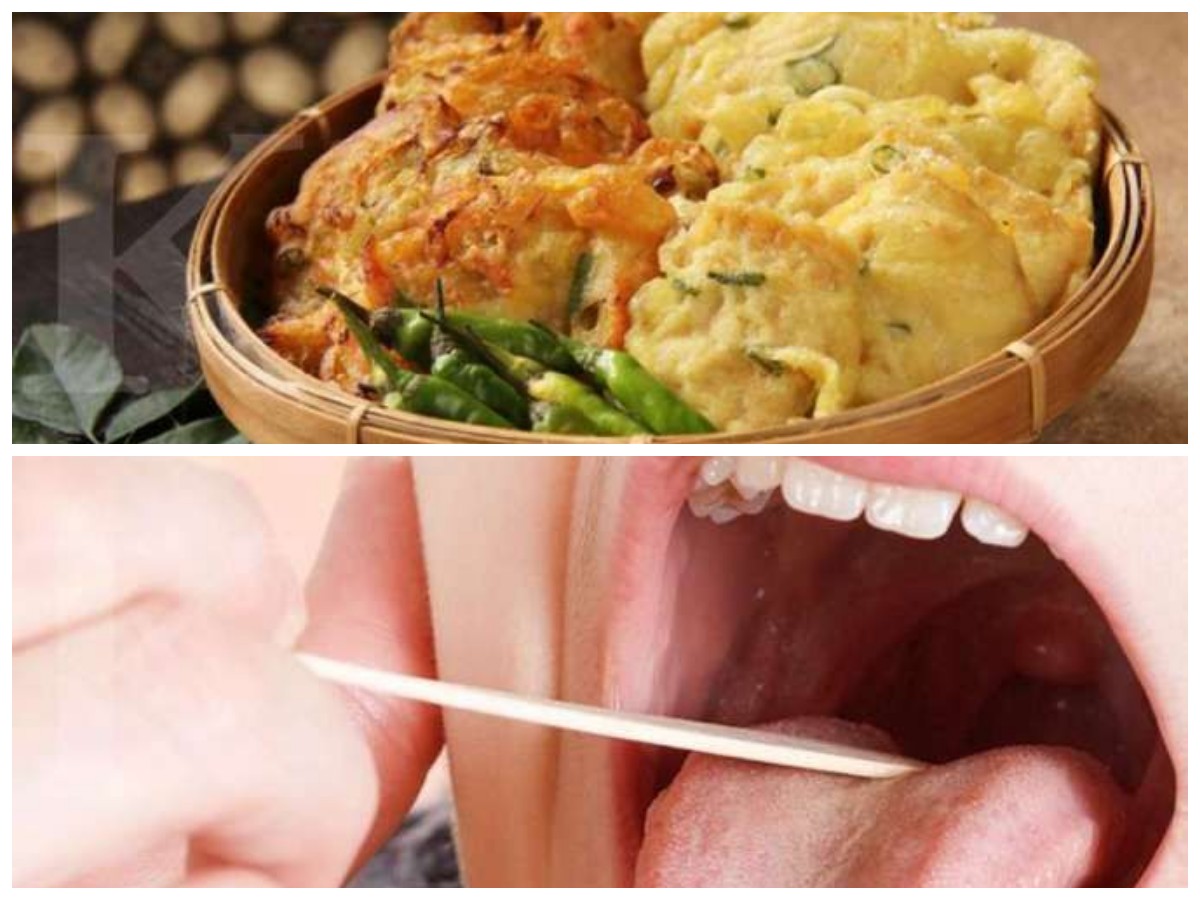 6 Makanan dan Minuman yang Harus Dihindari Jika Anda Punya Penyakit Amandel