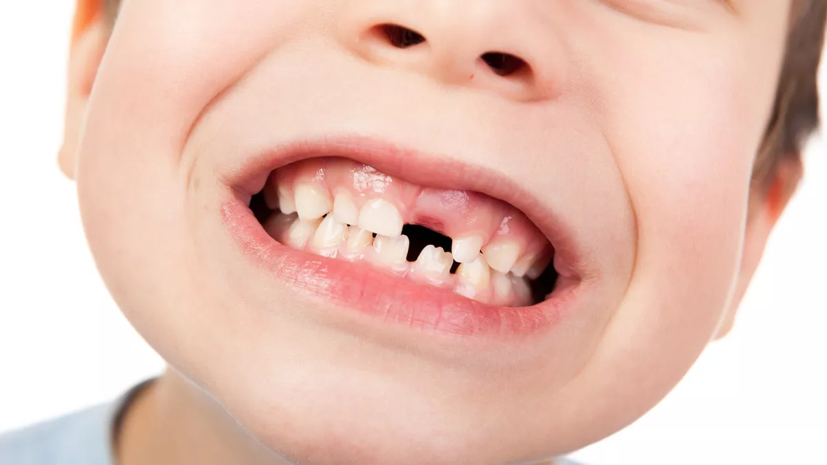 Mengatasi Masalah Gigi pada Anak, Penyebab dan Perawatan yang Tepat