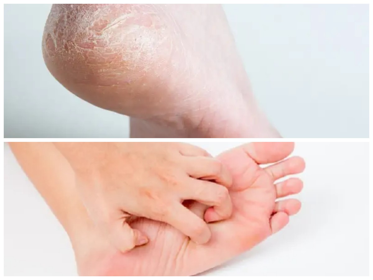 Mengapa Telapak Kaki Gatal? Kenali Penyebab dan Solusinya