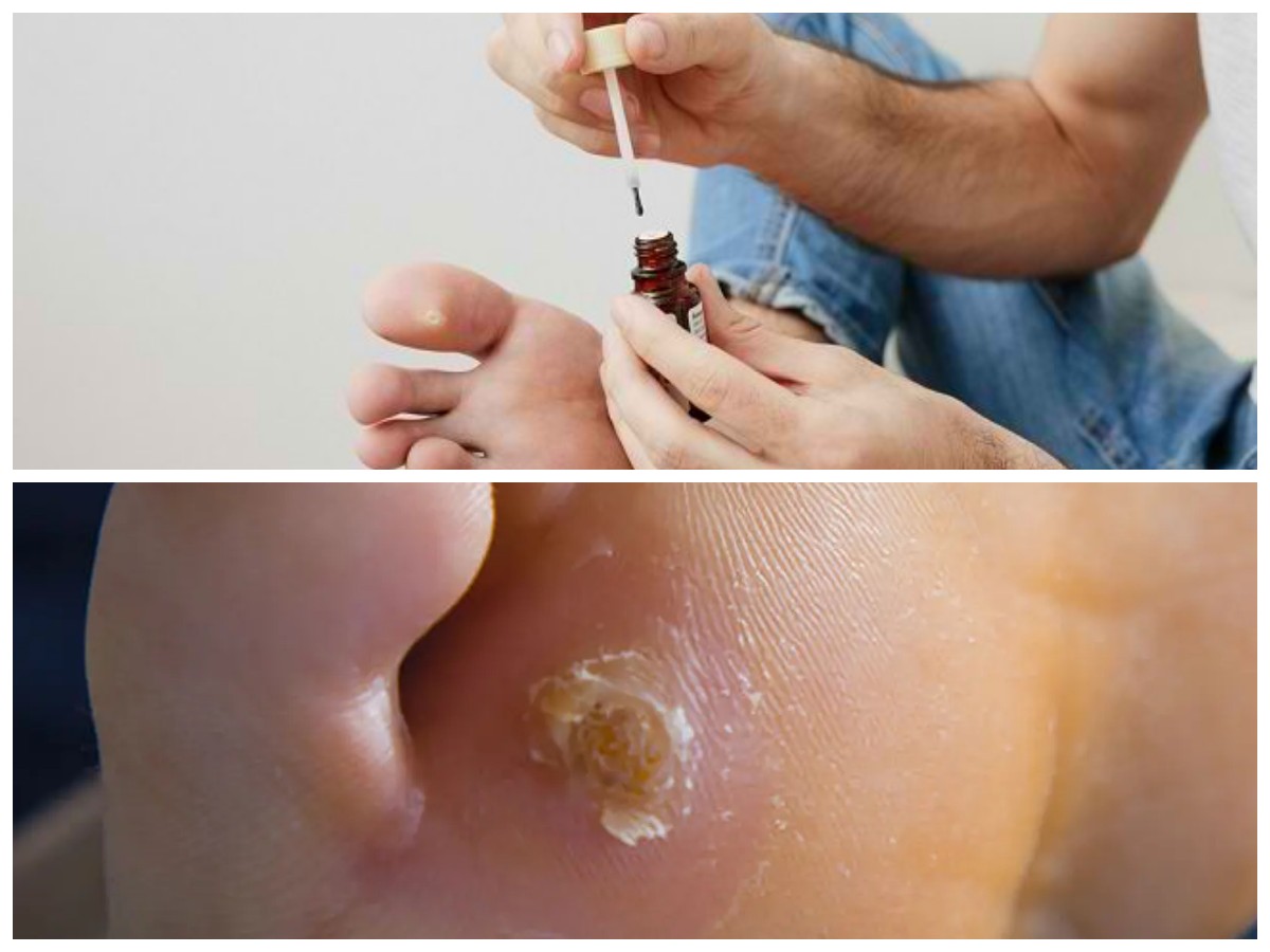 Mata Ikan Ganggu Aktivitas? Simak Cara Menghilangkannya Secara Alami dan Medis!