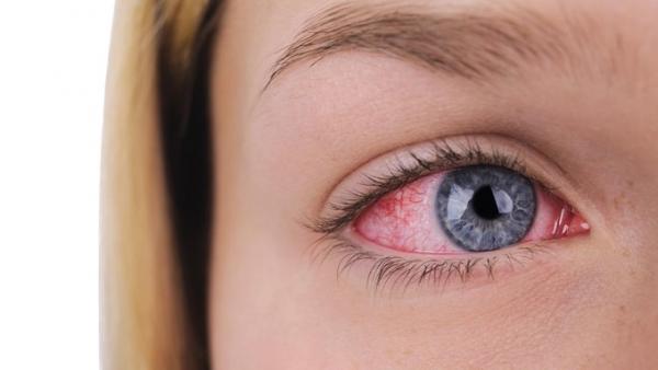 Sakit Mata: Kenali Penyebabnya dan Cara Pengobatannya 