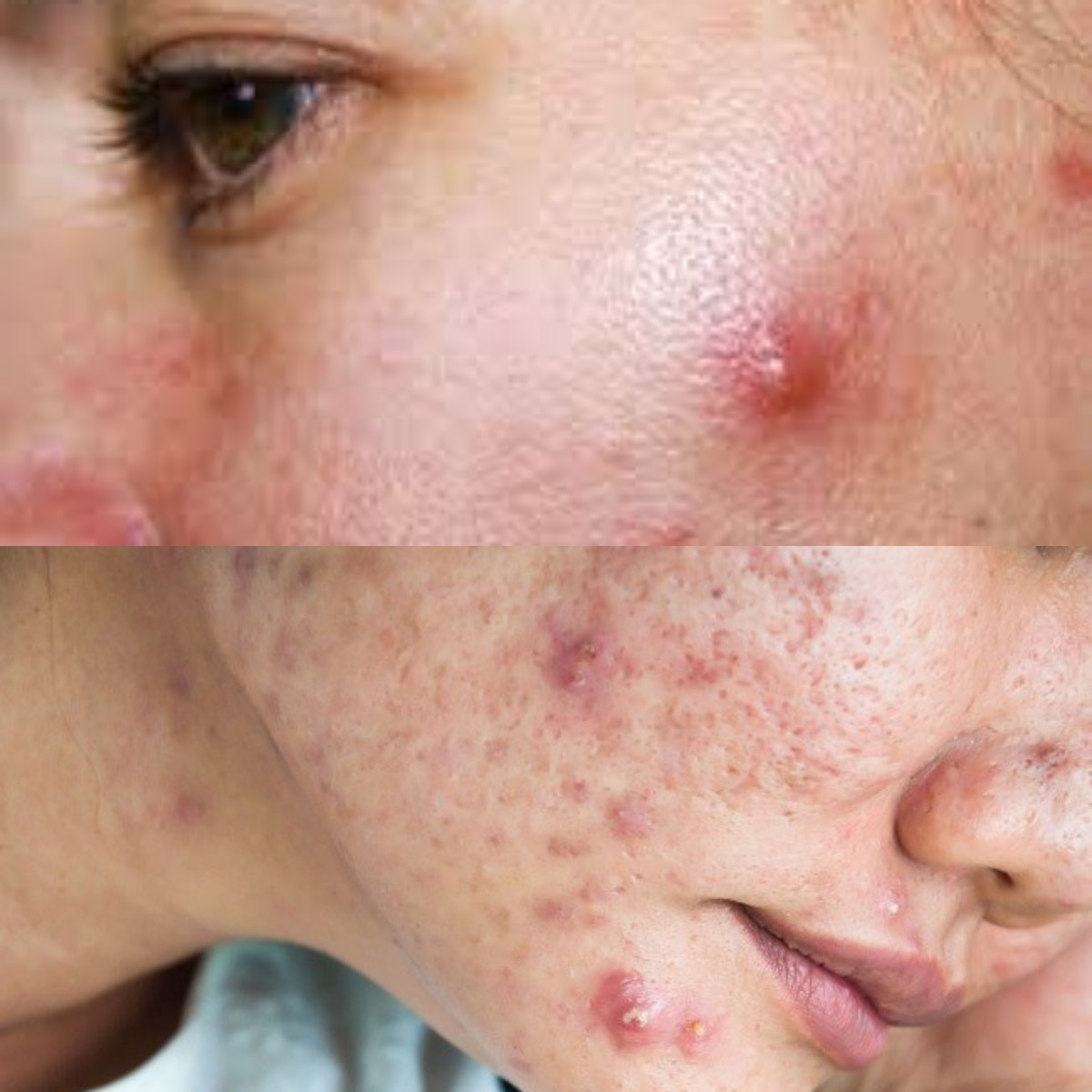 7 Metode Efektif dan Cepat untuk Mengatasi Jerawat Batu!