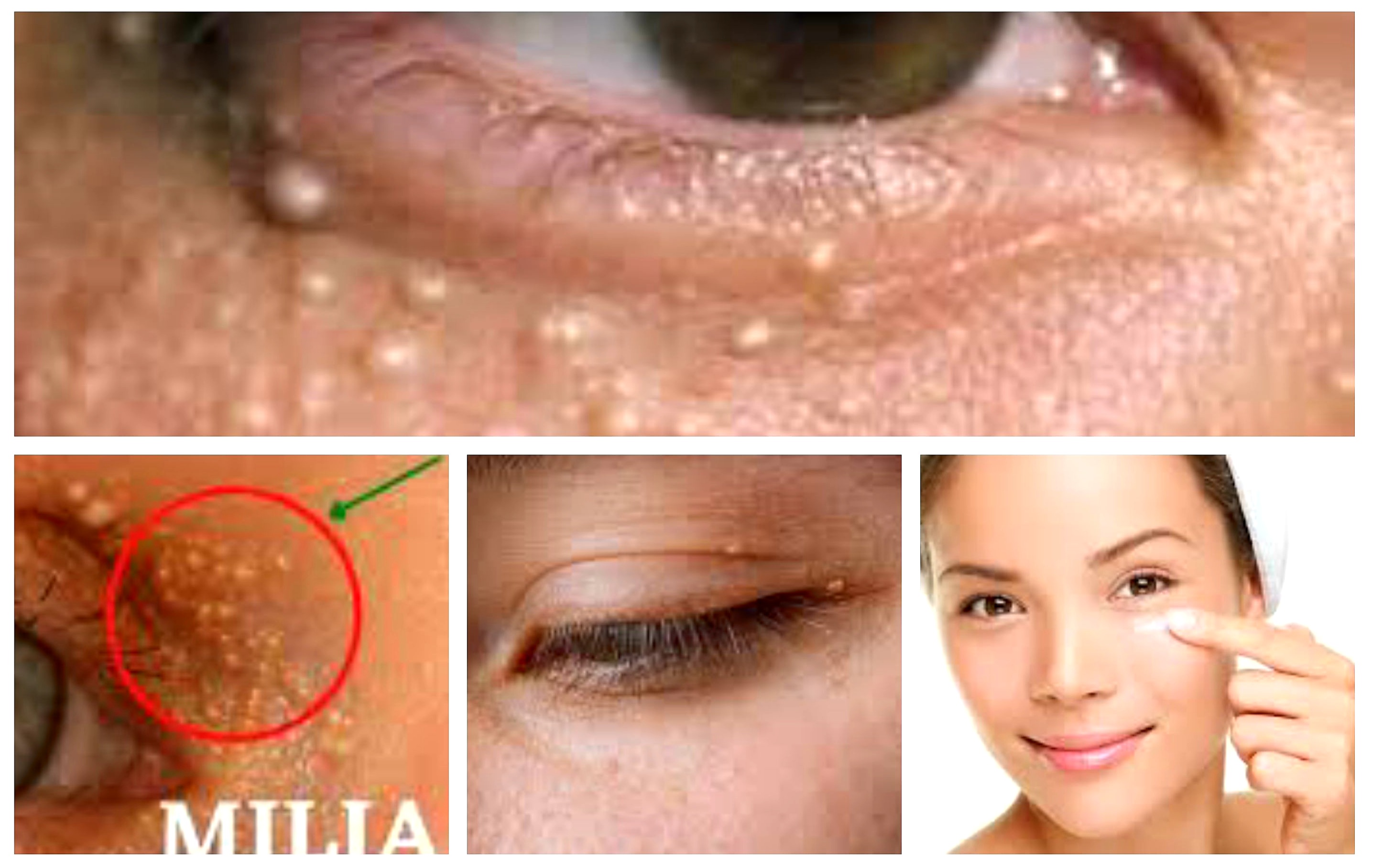 Medis dan Non Medis. Ini Tips Mengatasi dan Mencegah Bintik Putih di Bawah Mata