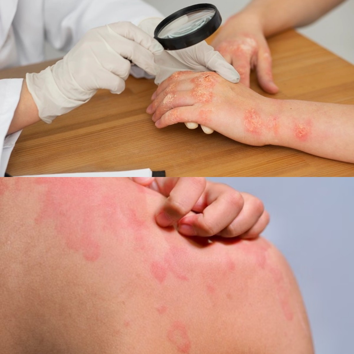 5 Tipe Infeksi Kulit Akibat Bakteri dan Cara Mengatasinya