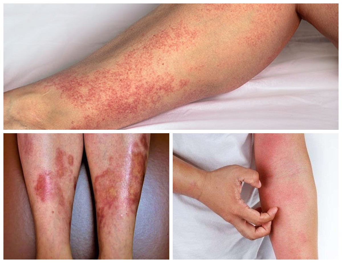 Gatal Tak Kunjung Hilang? Bisa Jadi Gejala Diabetes—Kenali Penyebabnya!