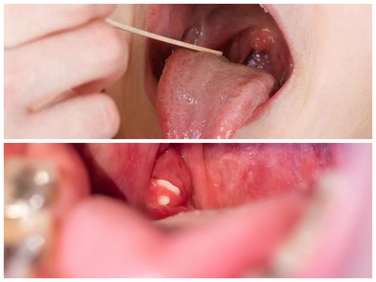 Batu Amandel Bisa Picu Bau Mulut Membandel? Ini Penyebab dan Solusinya