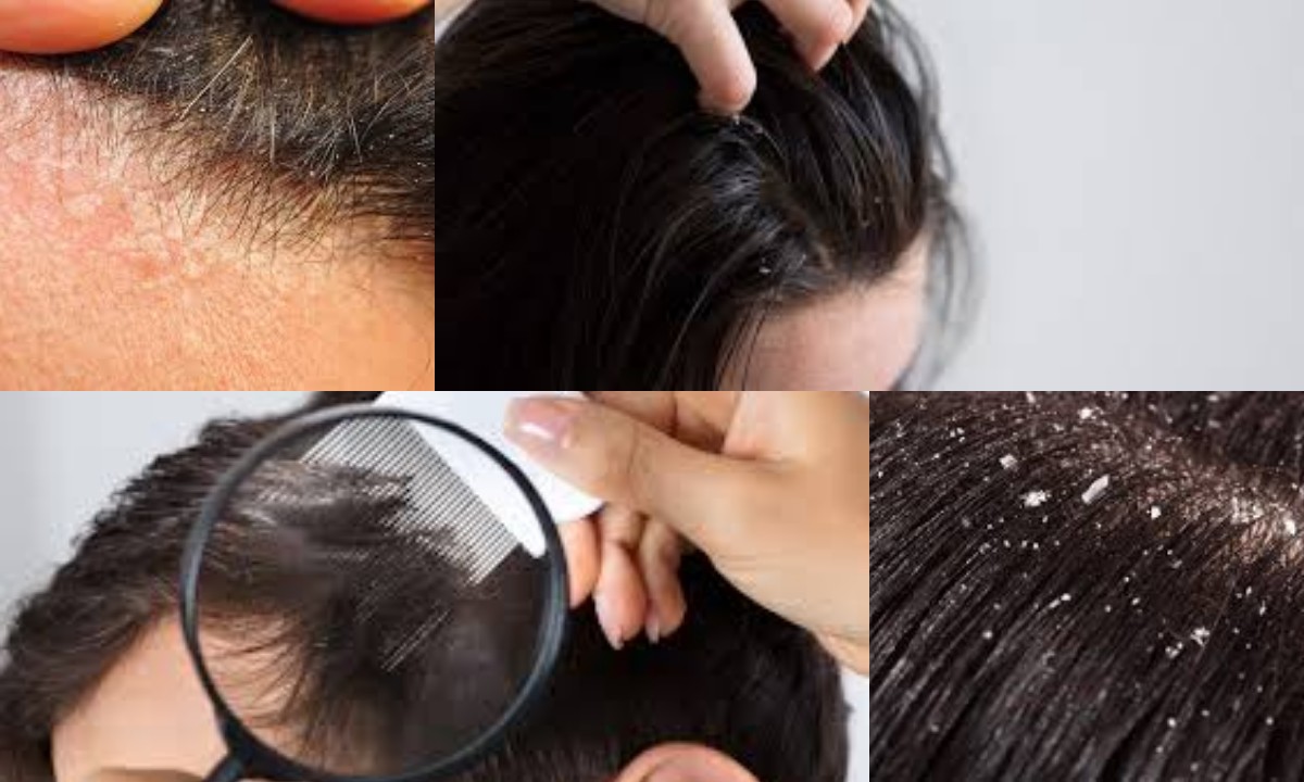 Sama-sama Menyebabkan Gatal, Ini Dia Perbedaan Antara Ketombe dan Dermatitis Seboroik!