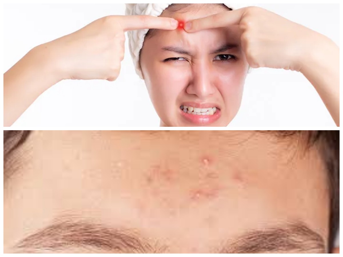 Jerawat di Dahi Tak Kunjung Hilang? Ini Penyebab dan Solusi Efektifnya