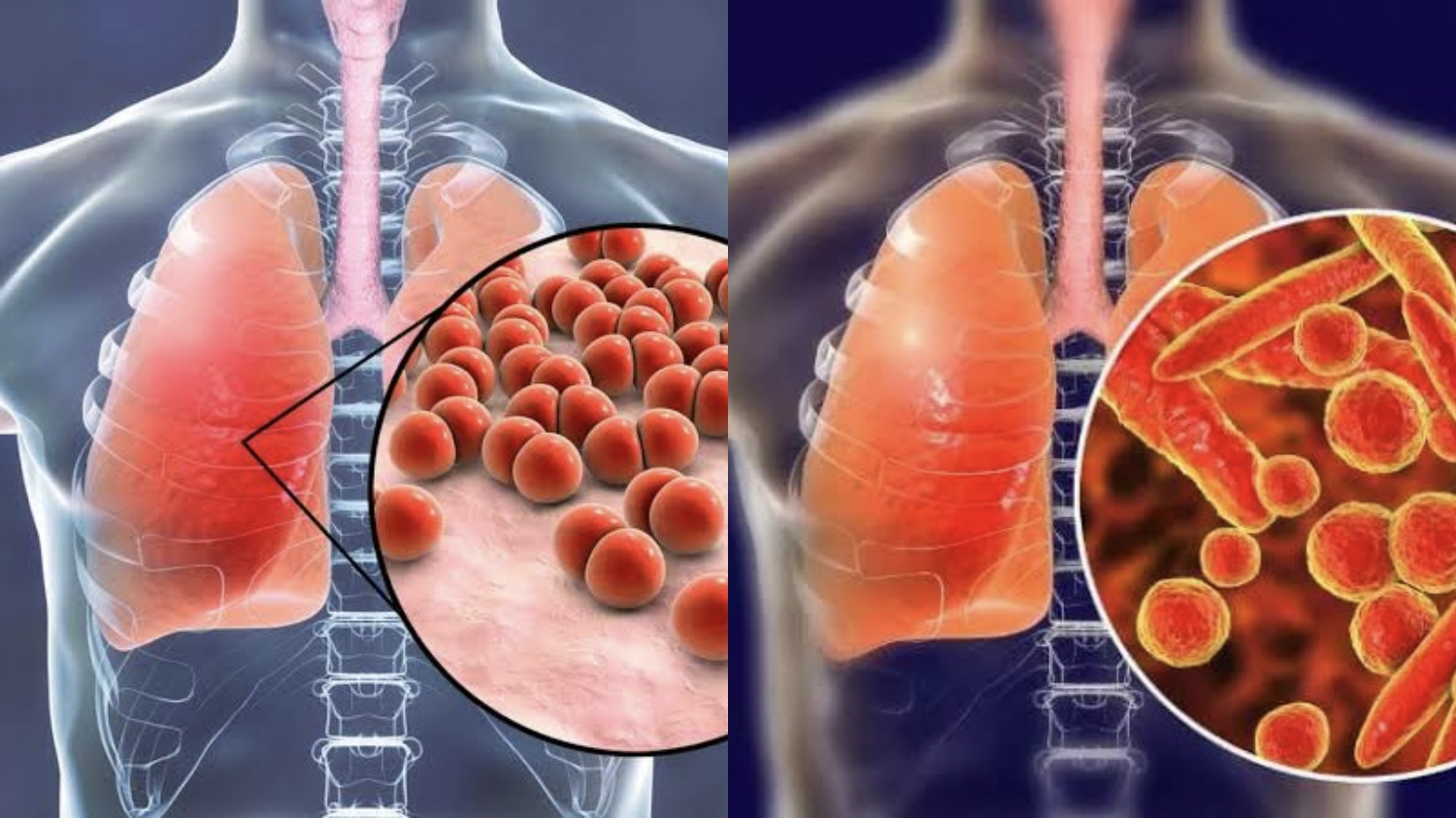 Apa Itu Pneumonia? Kenali Gejala dan Penyebabnya!