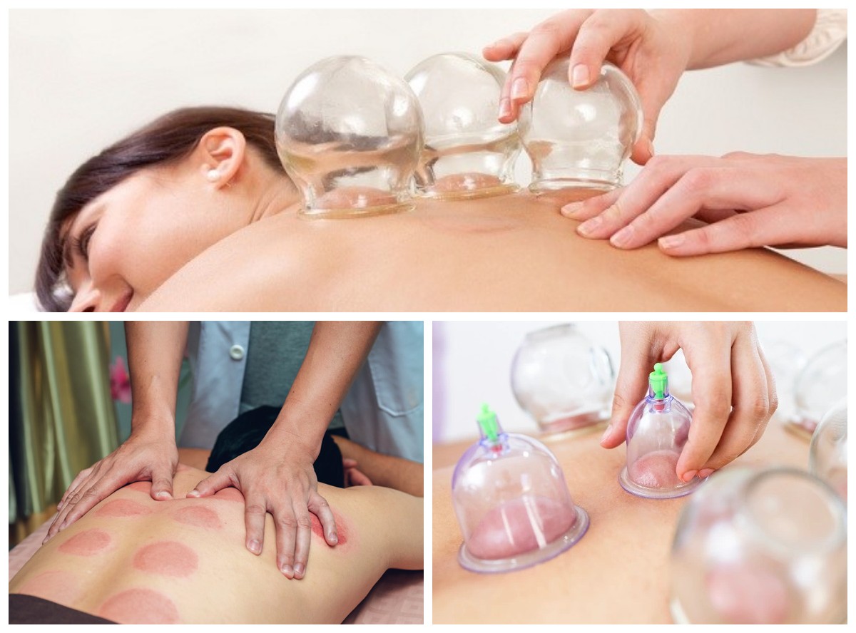 Rahasia di Balik Terapi Bekam di Kepala: Antara Manfaat dan Risiko Kesehatan!