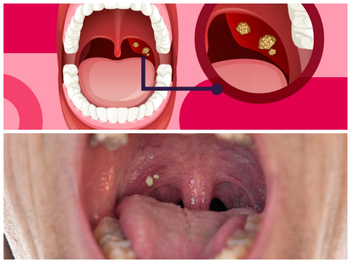 Rahasia di Balik Bau Mulut: Kenali Batu Amandel dan Solusi Alami untuk Mengatasinya