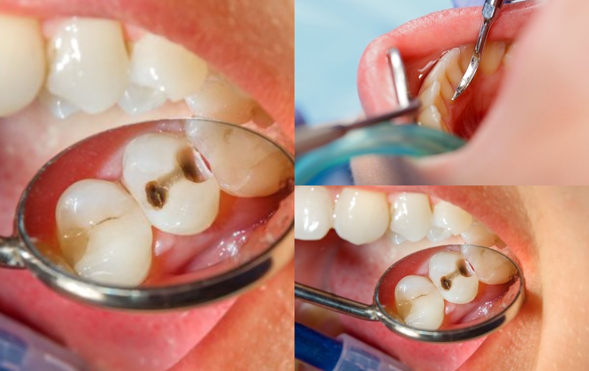 Apa Saja Efek dari Karang Gigi dan Tips Mencegahnya?