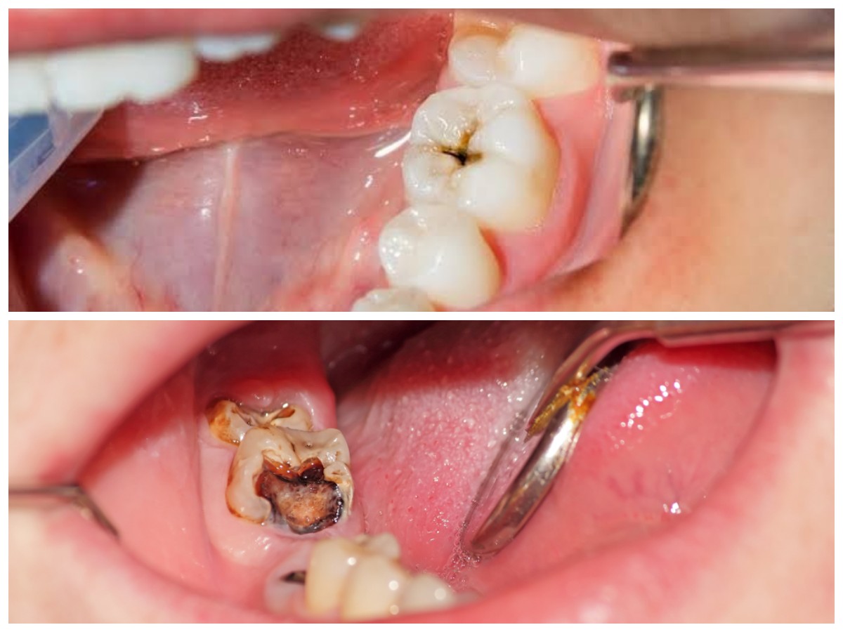 Cara Alami Mengatasi Gigi Berlubang: Solusi Praktis Tanpa Perlu ke Dokter